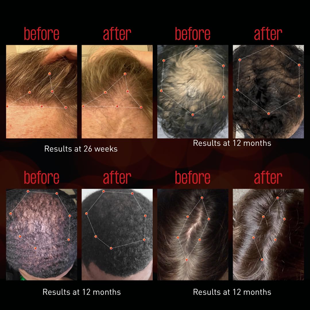 REVIAN Lyte Cap Hair Growth Device LED Wireless FDA Cleared Red Light Therapy, Hair Loss Treatment for Men + Women, Thinning, Regrowth & Alopecia