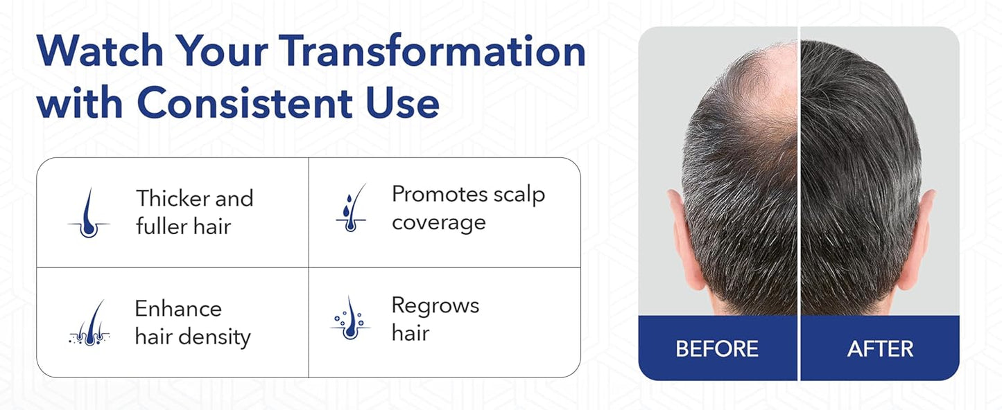 Hair-Regen Advanced 5% Minoxidil For Men Hair Regrowth Treatment for Thinning Hair - Hair Loss for Men - 6 Month Supply, Minoxidil Topical Solution So Thicker Fuller Hair Keeps Growing Amazing Results