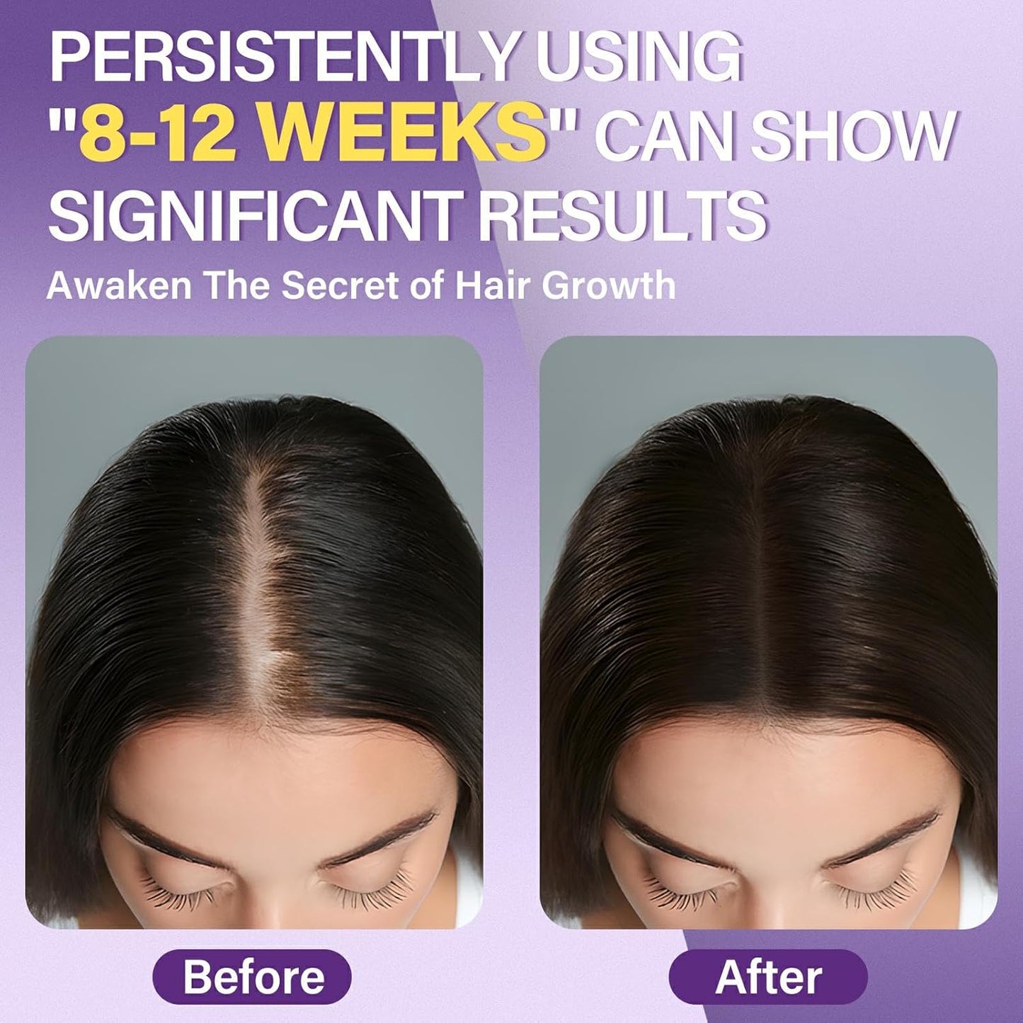 5% Minoxidil Foam for Women Hair Growth Foam Suitable for Hair Thinning Receding Hairline and Hair Loss to Hair Regrowth Get Thicker Fuller Hair 1 Bottles 2.11 Ounces Each