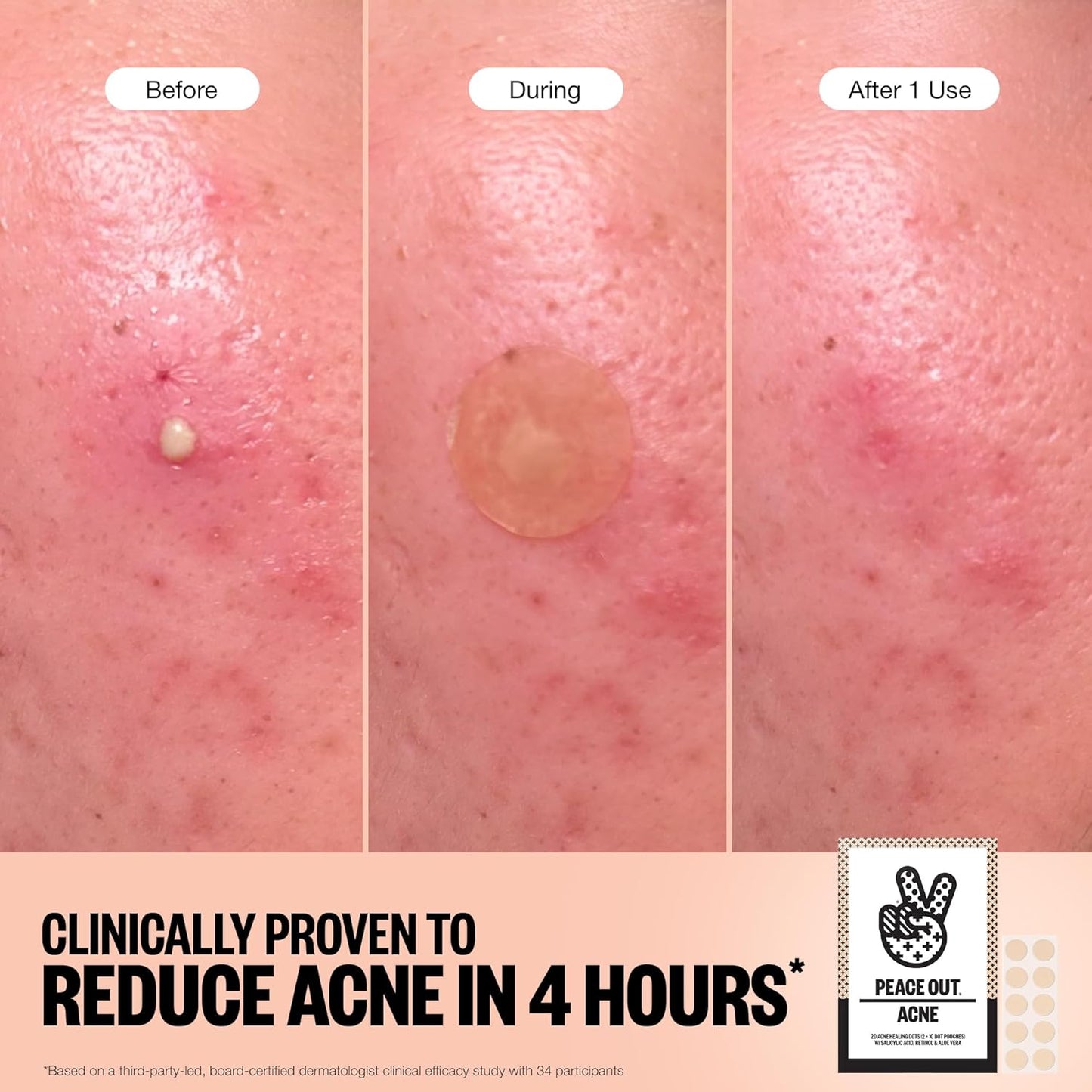 PEACE OUT Acne Healing Dots Helps Clear Blemishes Overnight, Fast Acting Hydrocolloid Pimple Patches for Breakouts with Salicylic Acid, Retinol and Aloe Vera, Award Winning Skincare Solution 10 Count