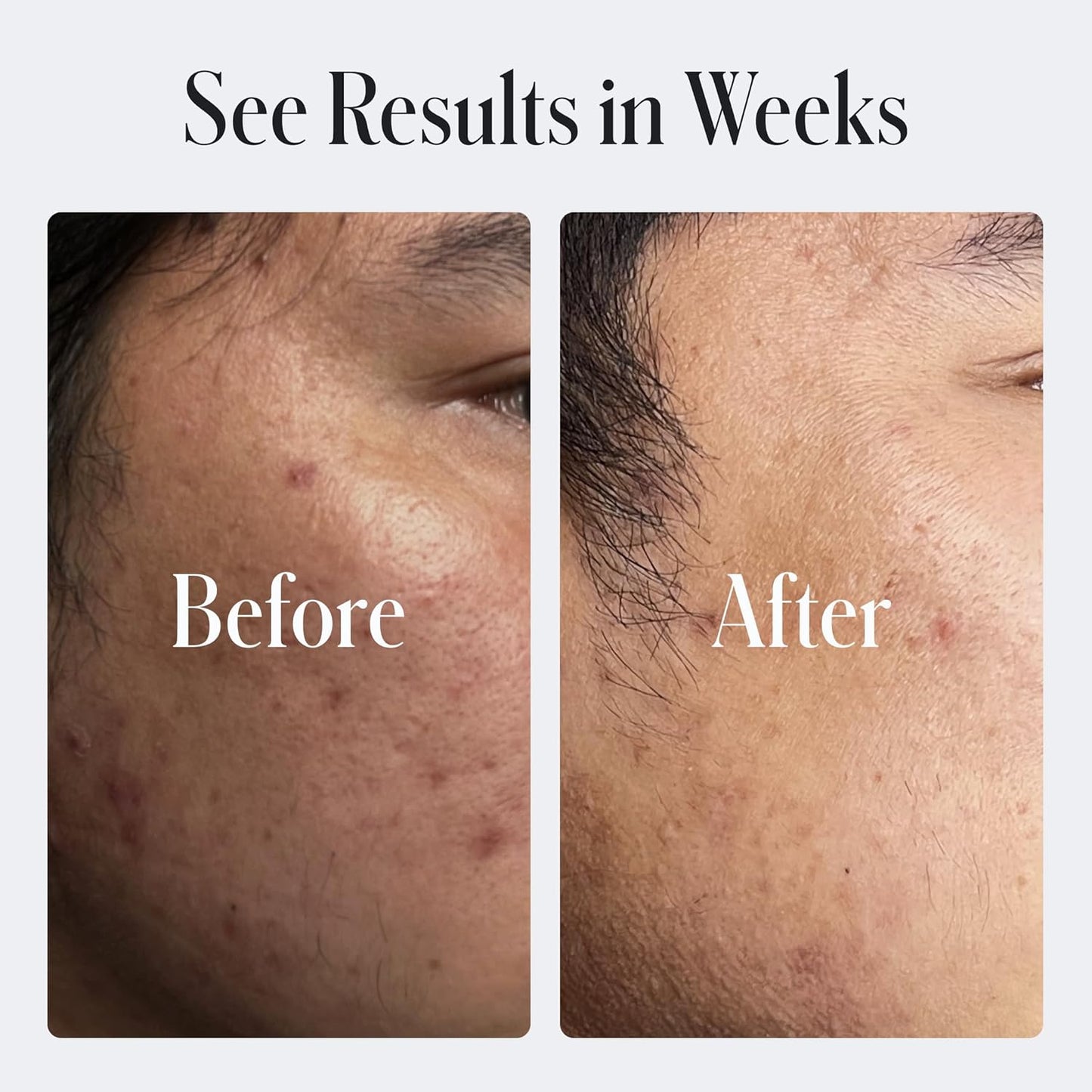 Geologie Skin Repair Moisturizer Face Cream | Clear System Retinol Resurfacing Formula | For Blemish Prone Skin with Niacinamide & Hyaluronic Acid | 60 ML